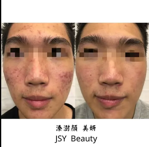 專業保養護理，讓弟弟重拾自信，燃燒青春的新起點｜台北問題肌膚處理｜汐止問題肌膚處理