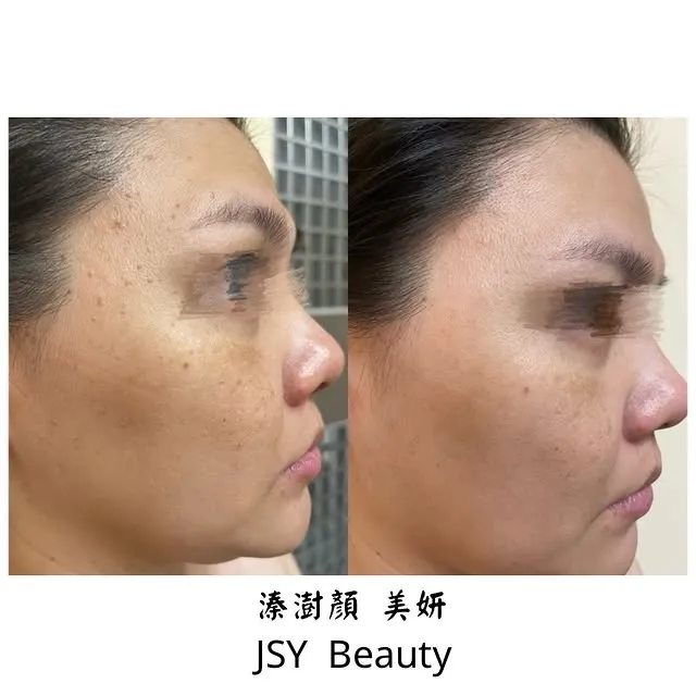 「角化斑處理」｜台北客製化肌膚保養｜汐止客製化肌膚保養