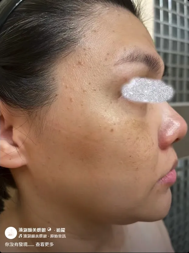 你沒有發現 臉上、眼周、脖子出現一些擠不出來、摸起來粗粗的小顆粒？