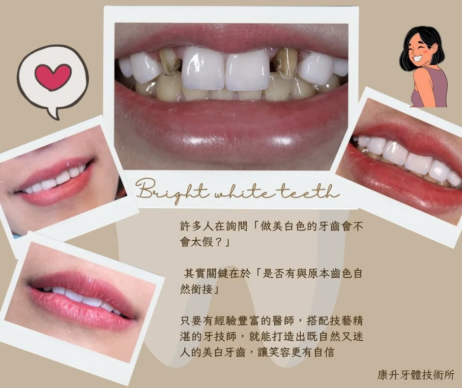 許多人在詢問做美白色的牙齒會不會太假?