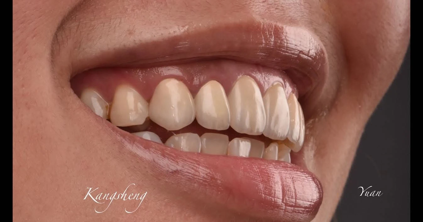 3-3 Zirconia veneer