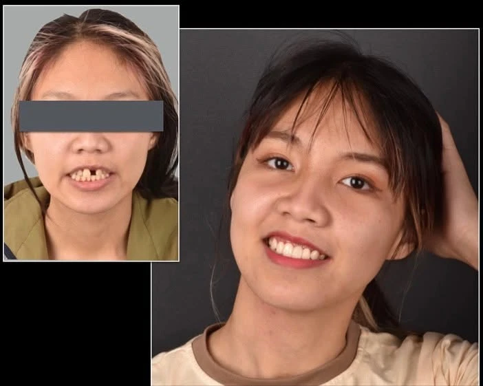 12-22 Zirconia 13.23Zirconia Venner