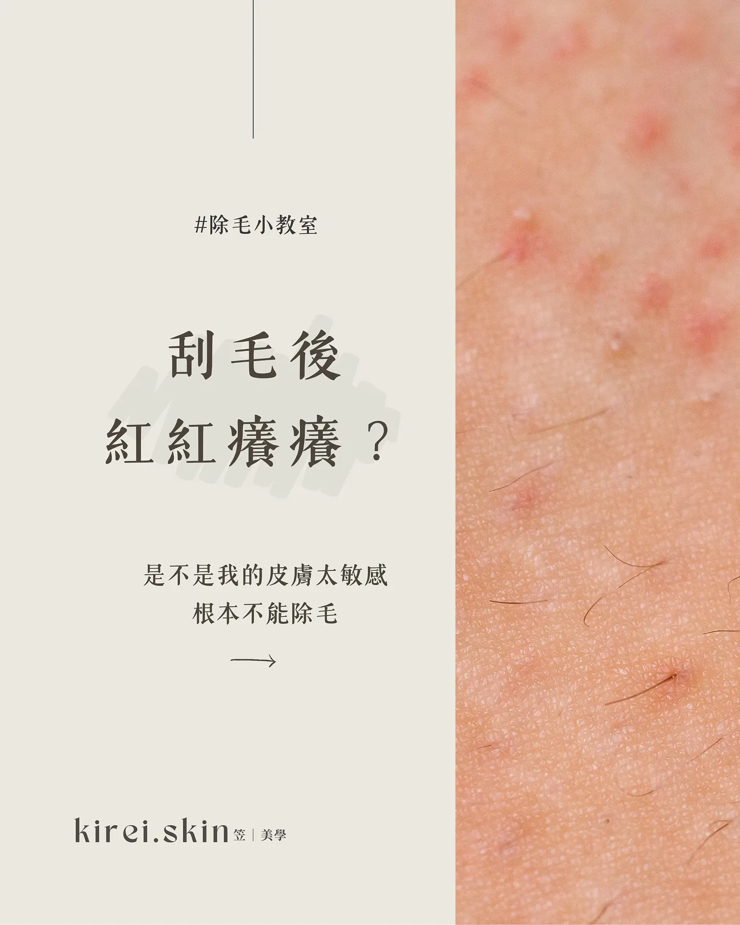 刮毛後紅紅癢癢？