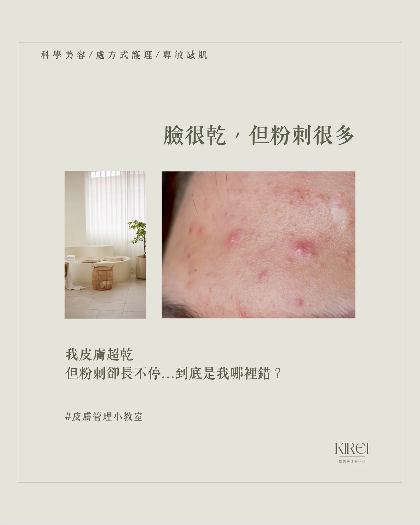 臉很乾，但粉刺很多？