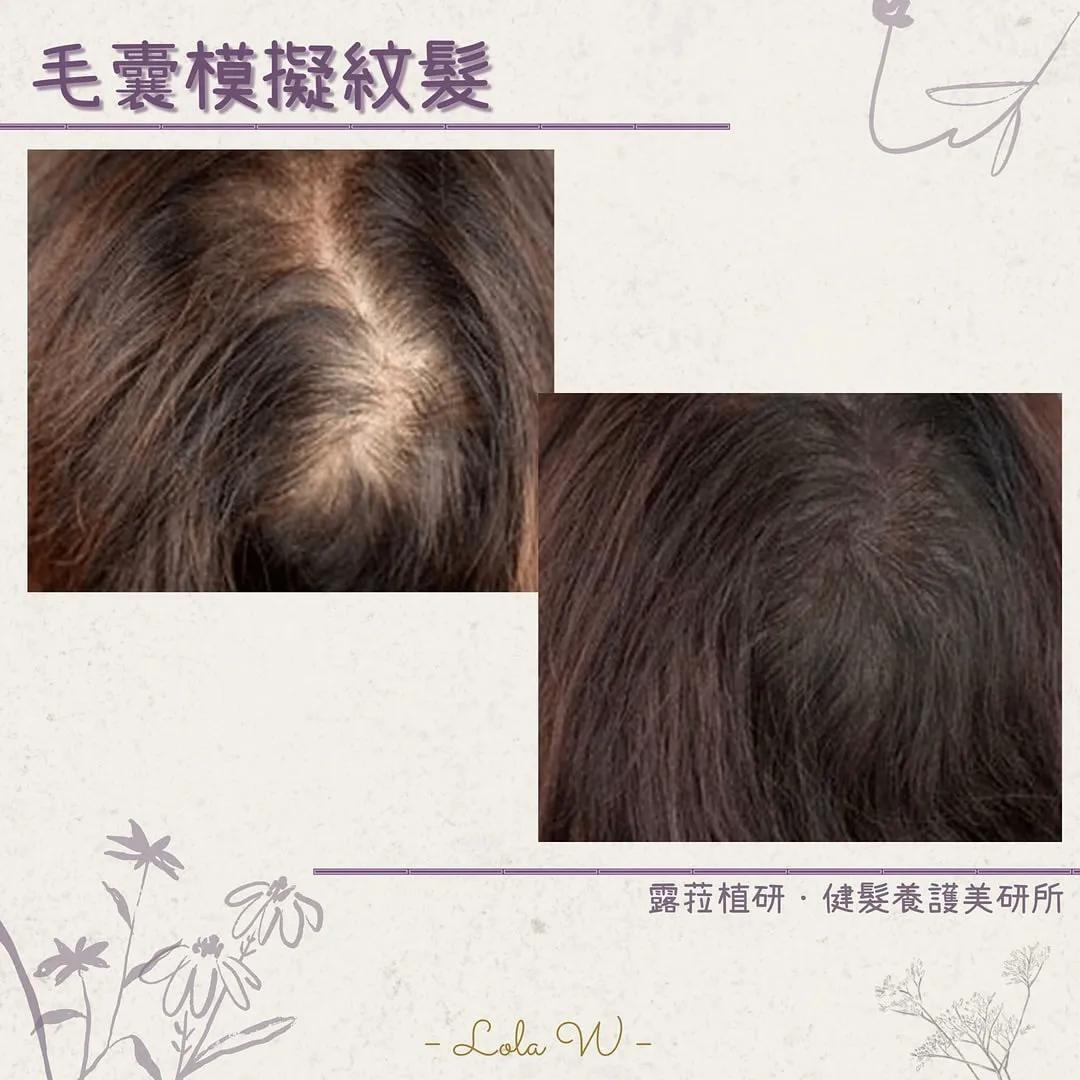 頭髮分線明顯、頭皮露白的最佳解決方案!  台中紋髮｜禿頭救星