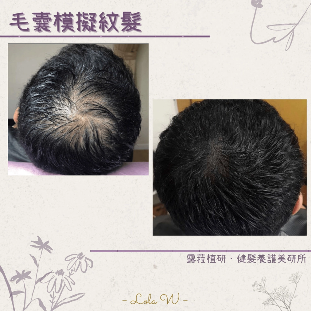 毛囊模擬紋髮 SMP