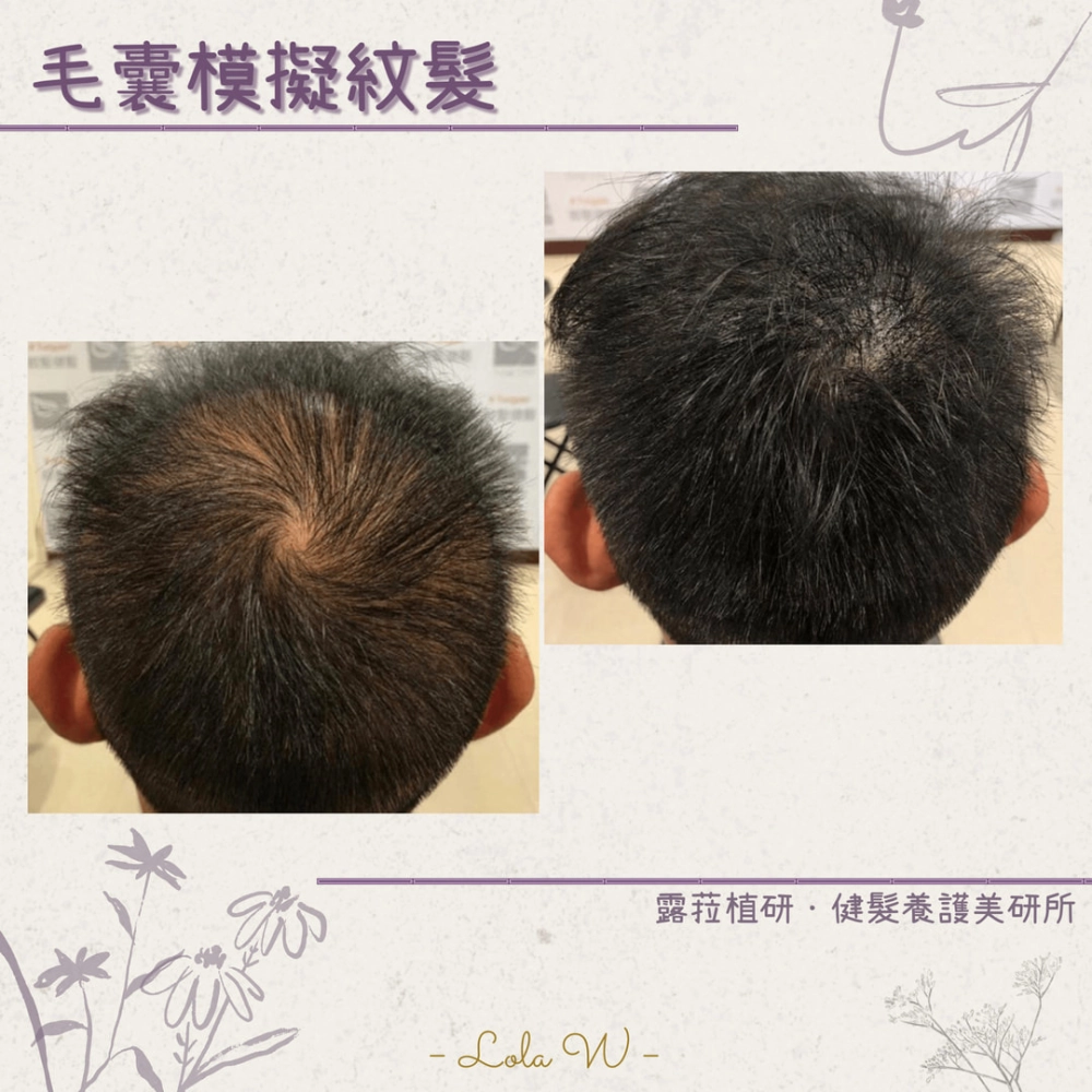 毛囊模擬紋髮 SMP