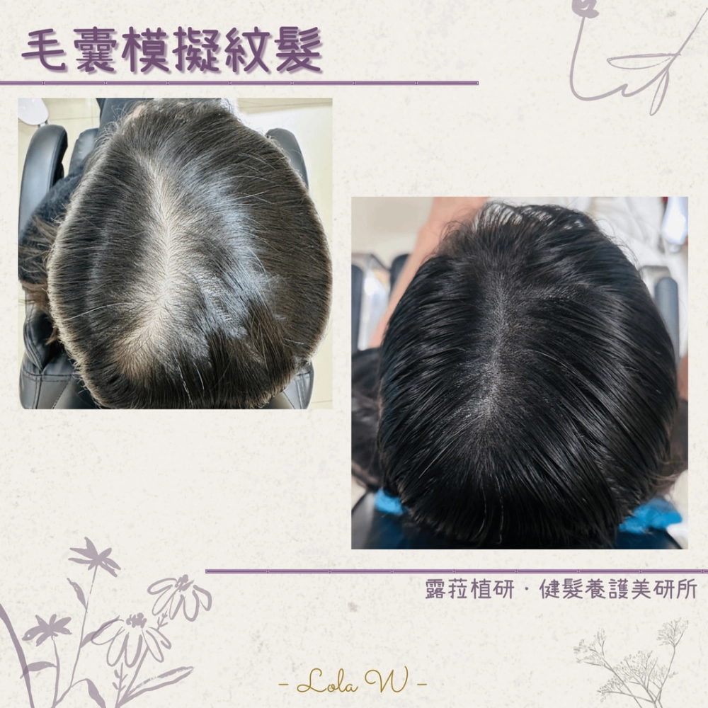 毛囊模擬紋髮 SMP