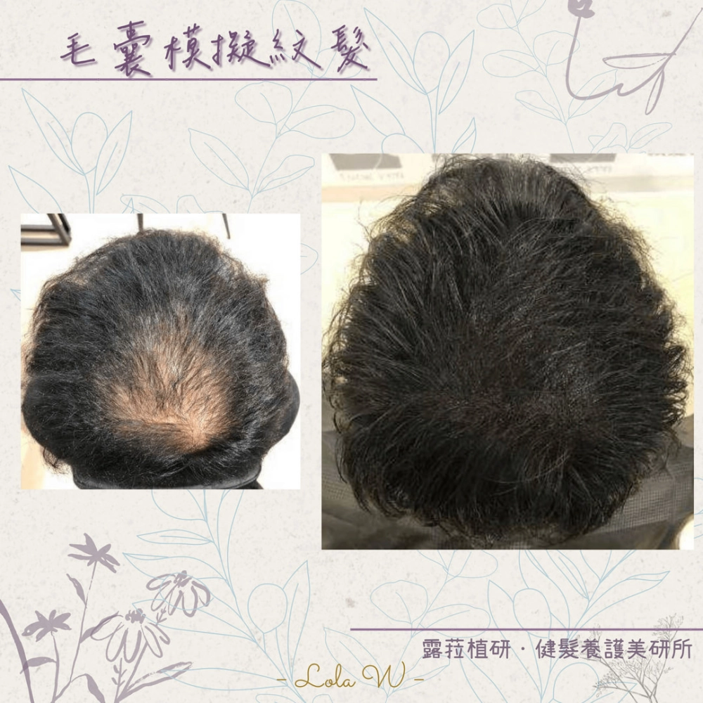 毛囊模擬紋髮 SMP