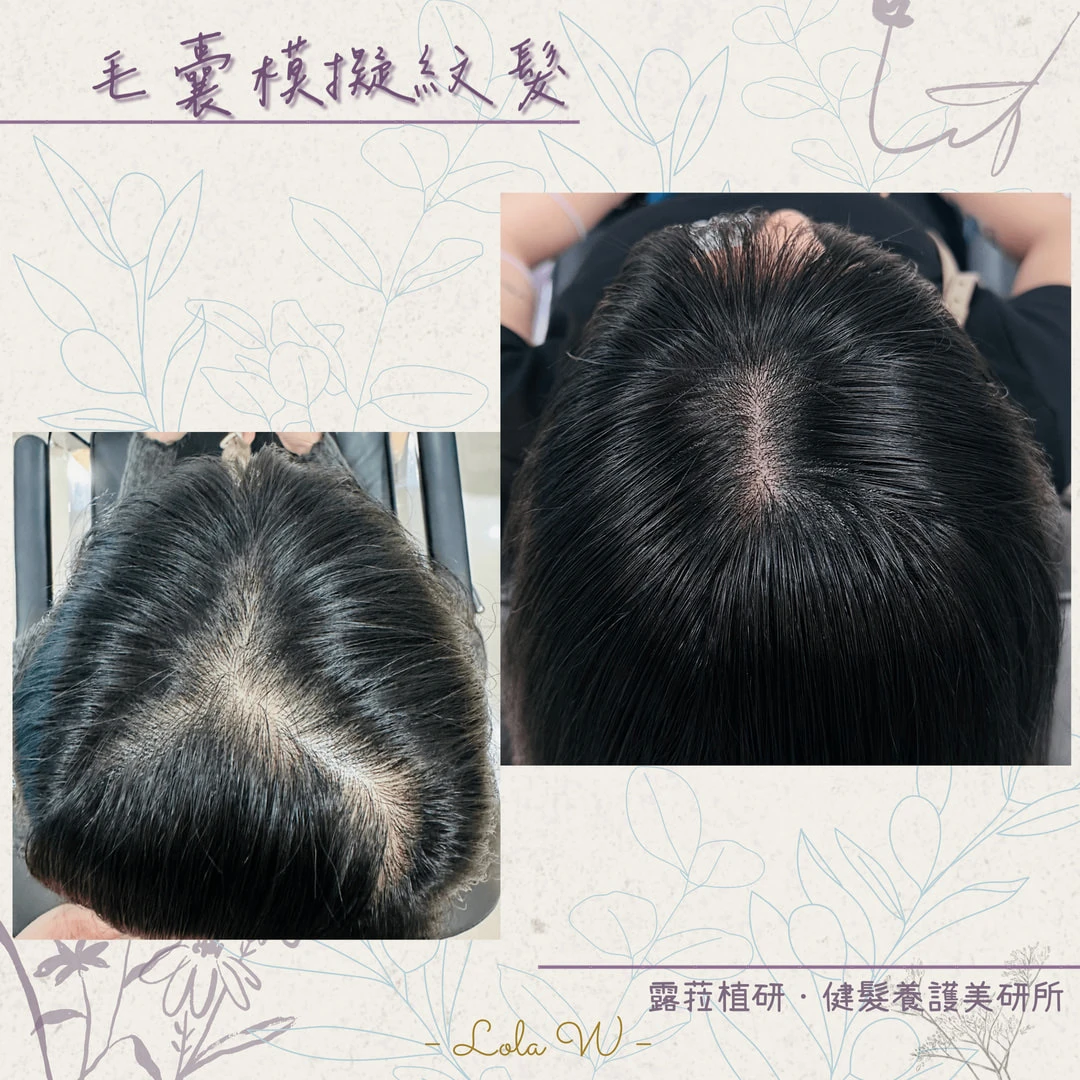 毛囊模擬紋髮 SMP