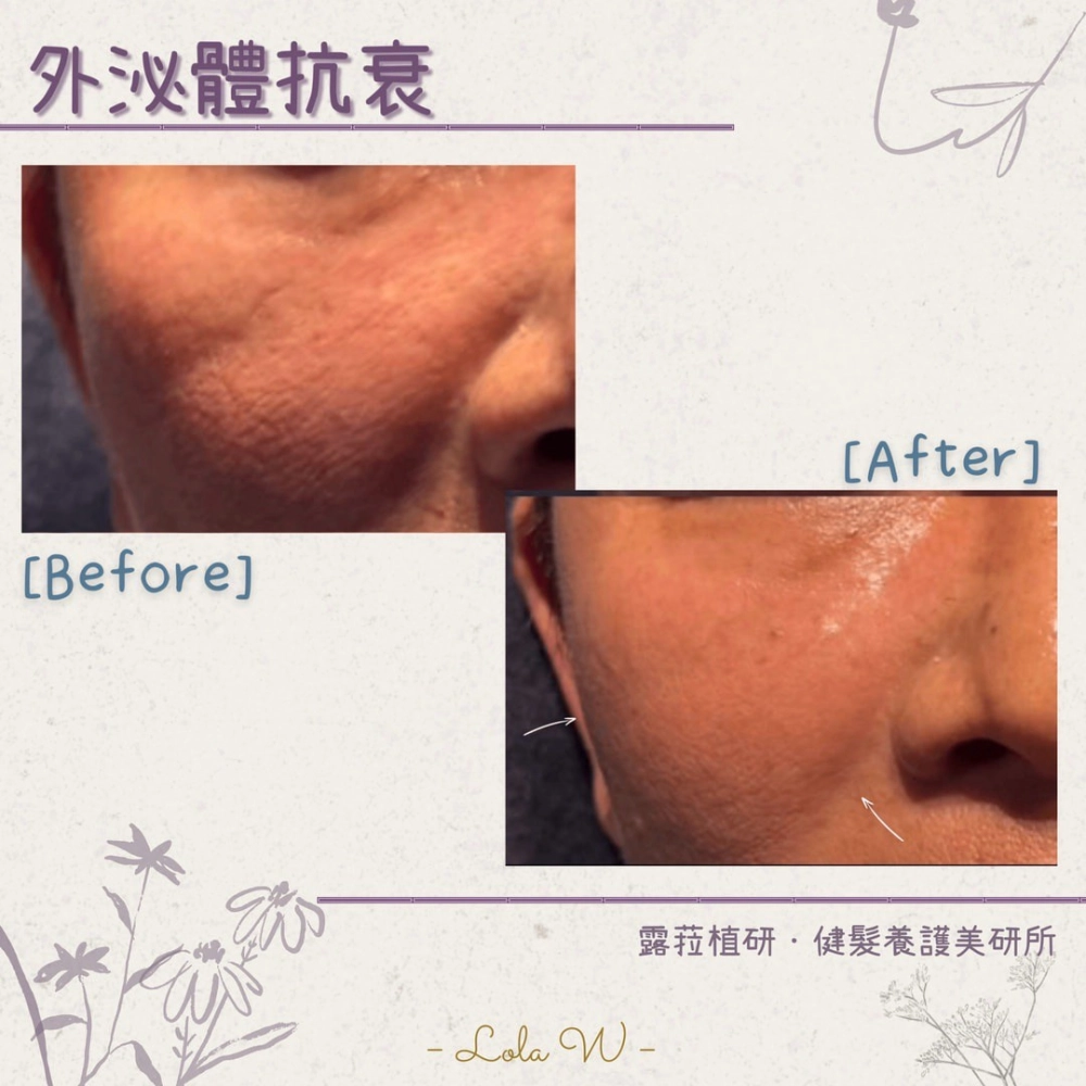 外泌體臉部抗衰 Exosome Facial Treatment