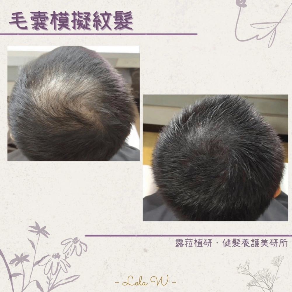毛囊模擬紋髮 SMP