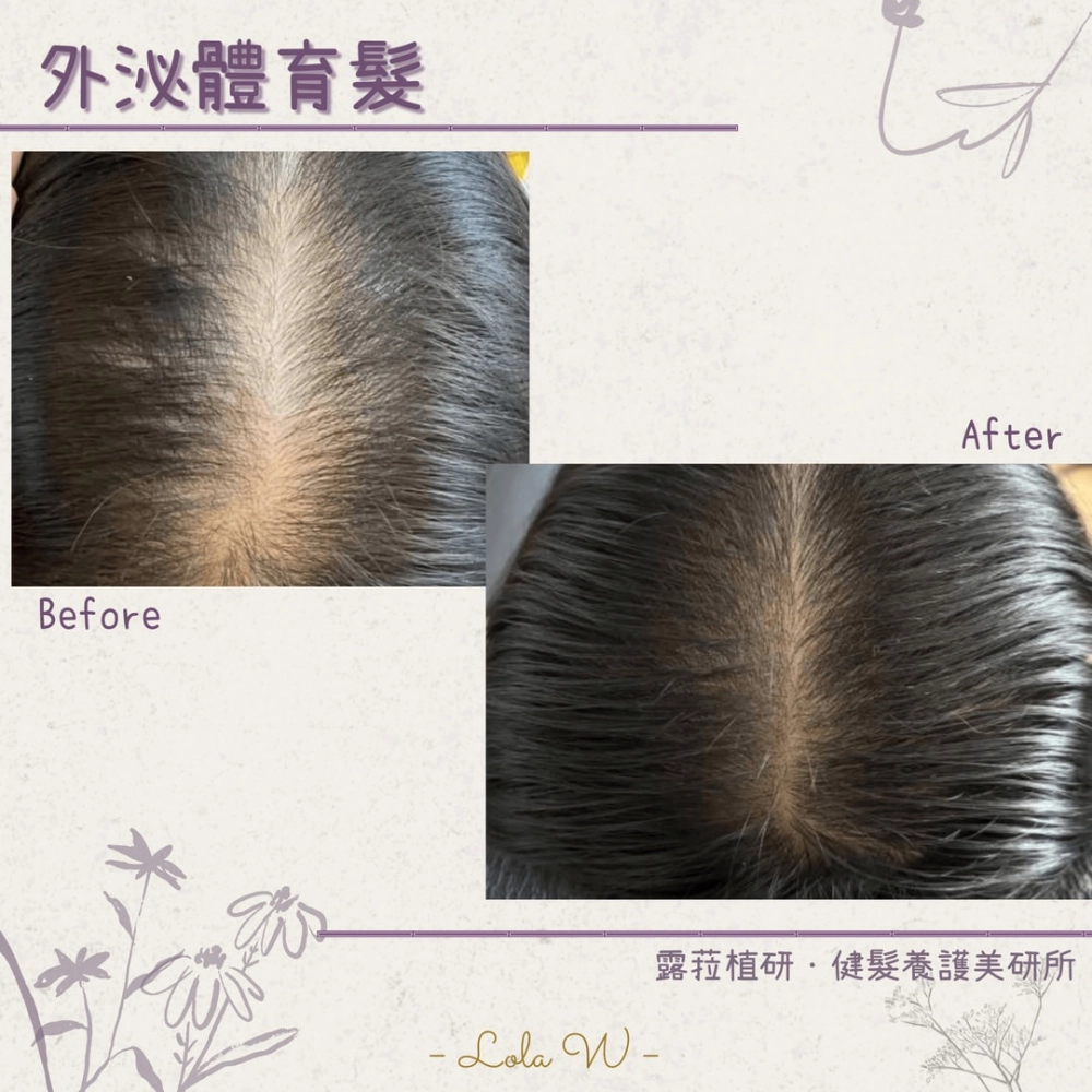 外泌體育髮 Exosome Hair Care