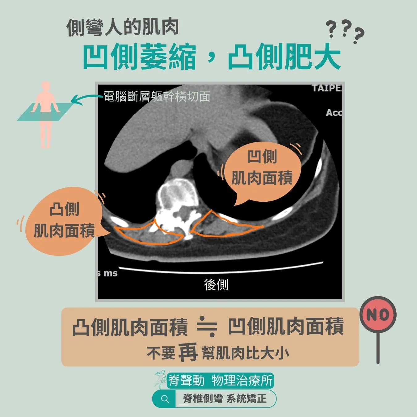 矯正脊椎側彎 要訓練什麼肌肉啊 ??!! 重訓、瑜珈、皮拉提斯 ??