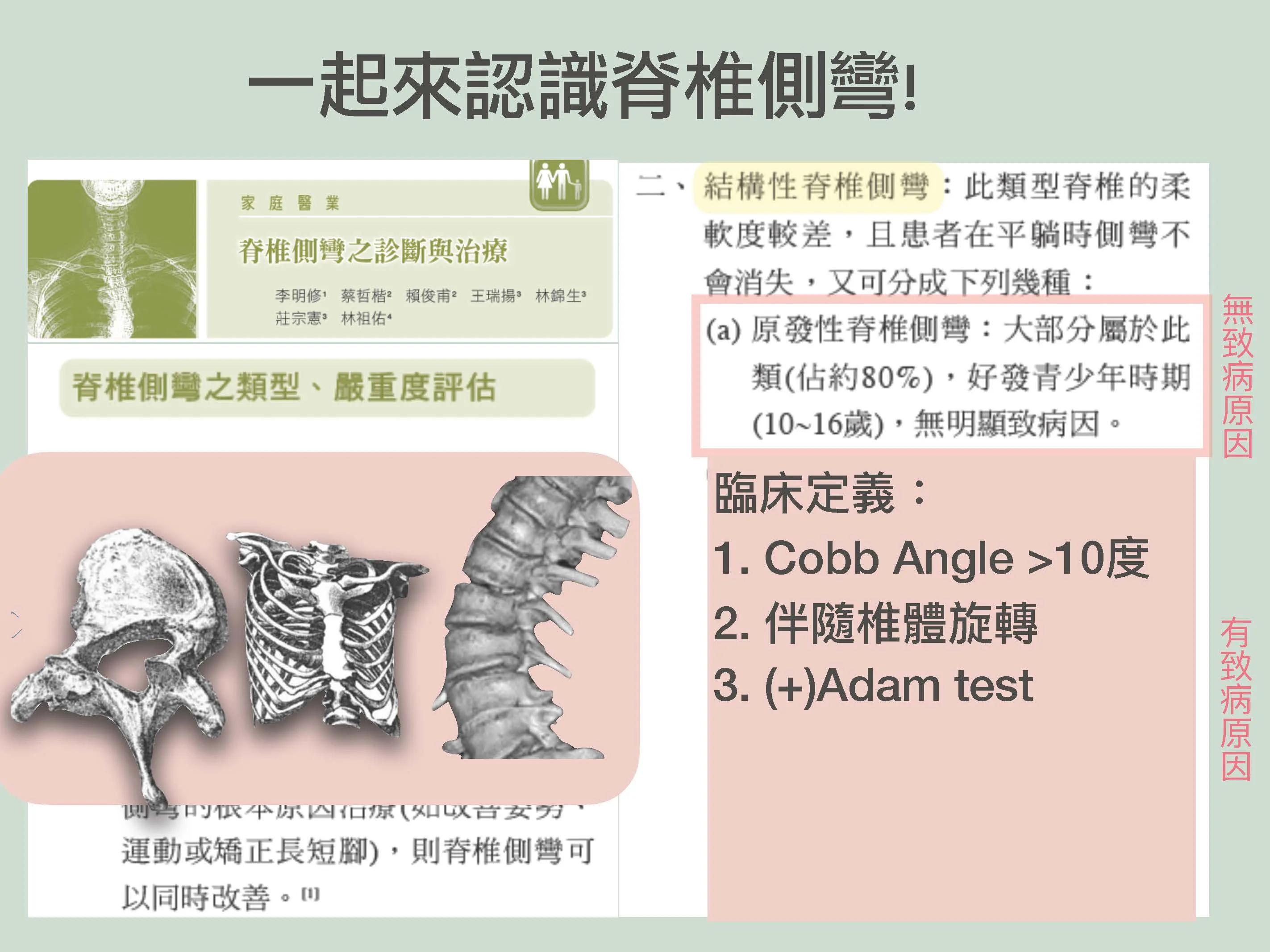 為什麼會脊椎側彎 ??--脊椎側彎 系統矯正 PSSE Schroth