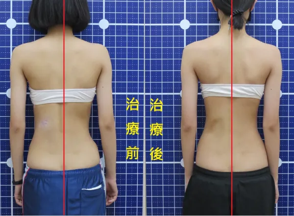 脊聲動 | 脊椎側彎 / 脊柱側彎  矯正成功分享