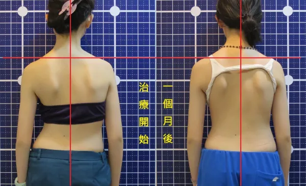 脊聲動 | 脊椎側彎 / 脊柱側彎  矯正成功分享