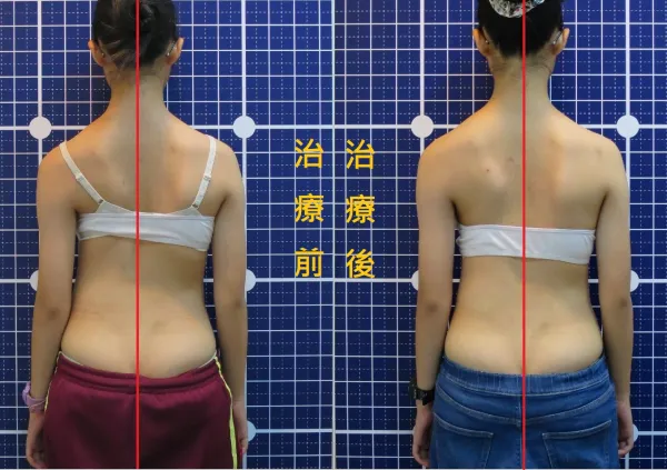脊聲動 | 脊椎側彎 / 脊柱側彎  矯正成功分享