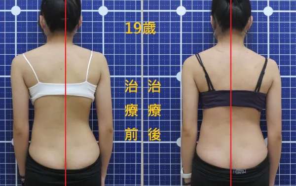 脊聲動 | 脊椎側彎 / 脊柱側彎  矯正成功分享