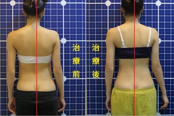 脊聲動 | 脊椎側彎 / 脊柱側彎  矯正成功分享
