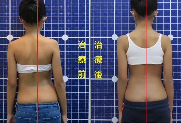 脊聲動 | 脊椎側彎 / 脊柱側彎  矯正成功分享