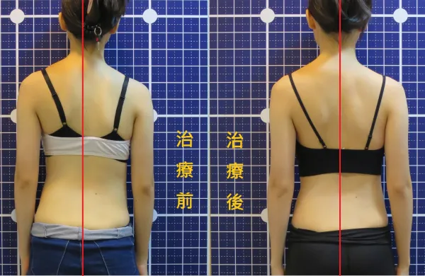脊聲動 | 脊椎側彎 / 脊柱側彎  矯正成功分享