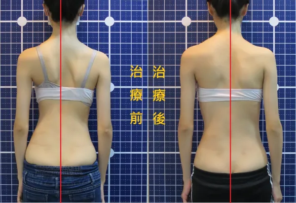 脊聲動 | 脊椎側彎 / 脊柱側彎  矯正成功分享