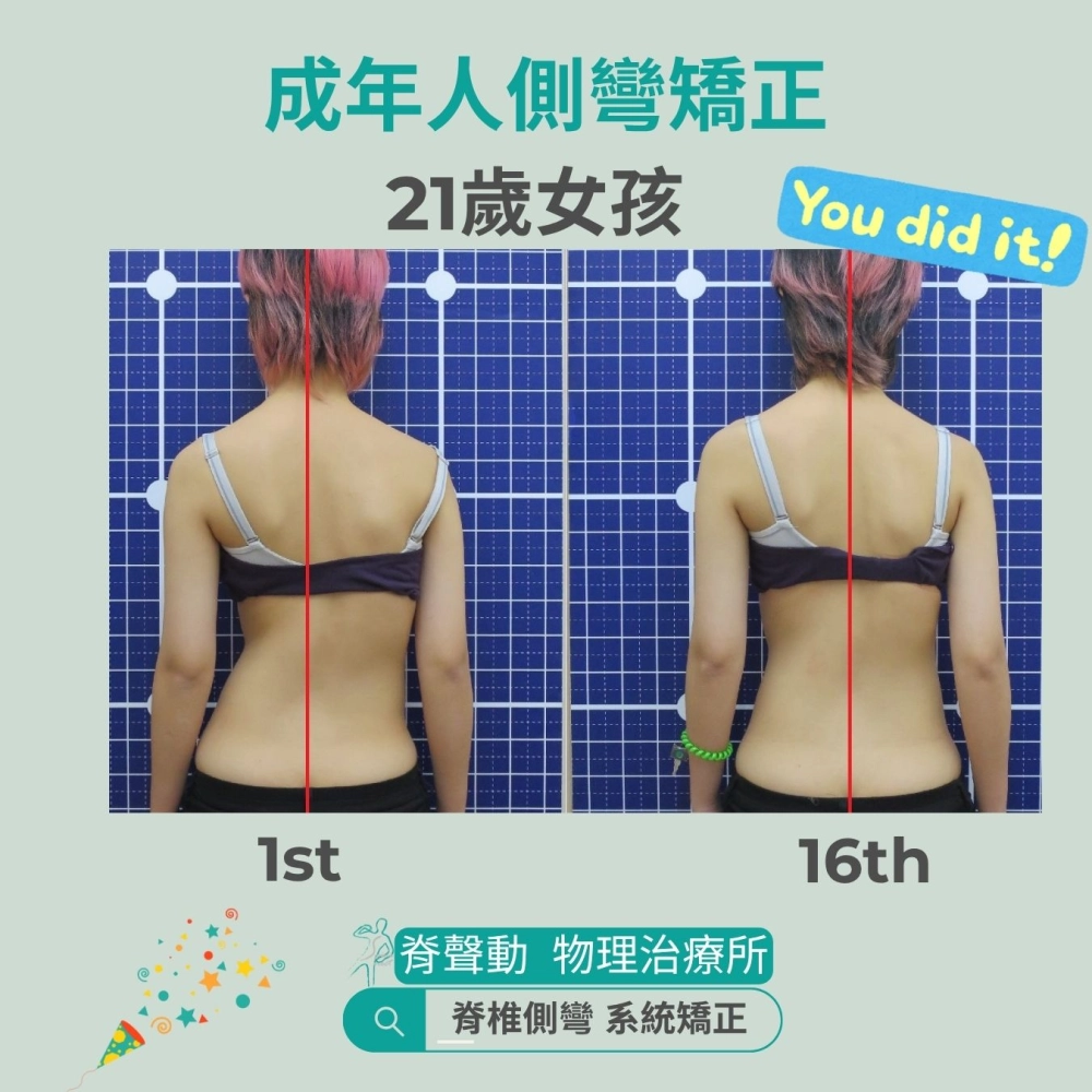脊聲動 | 脊椎側彎 / 脊柱側彎  矯正成功分享