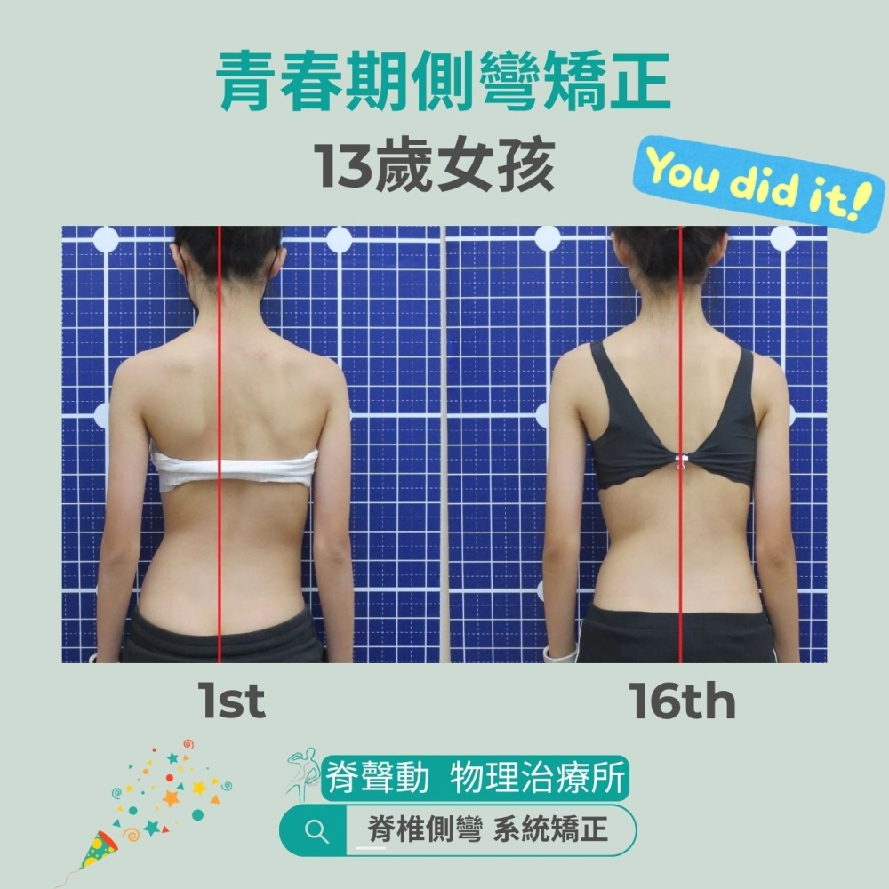 脊聲動 | 脊椎側彎 / 脊柱側彎  矯正成功分享