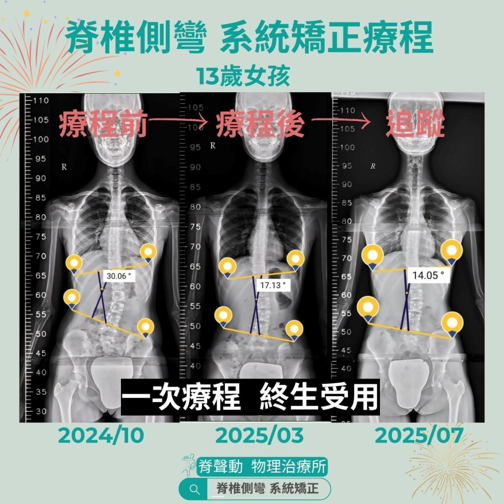 脊聲動 | 脊椎側彎 / 脊柱側彎  矯正成功分享