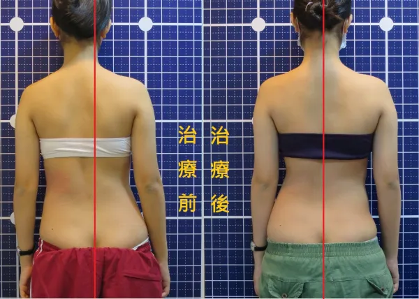 脊聲動 | 脊椎側彎 / 脊柱側彎  矯正成功分享