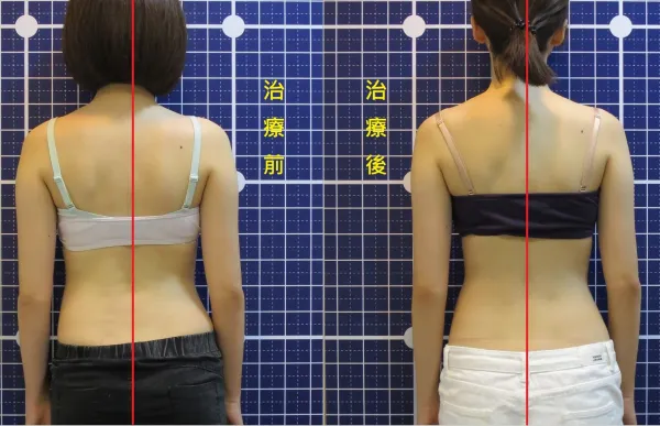 脊聲動 | 脊椎側彎 / 脊柱側彎  矯正成功分享