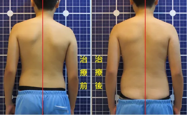 脊聲動 | 脊椎側彎 / 脊柱側彎  矯正成功分享