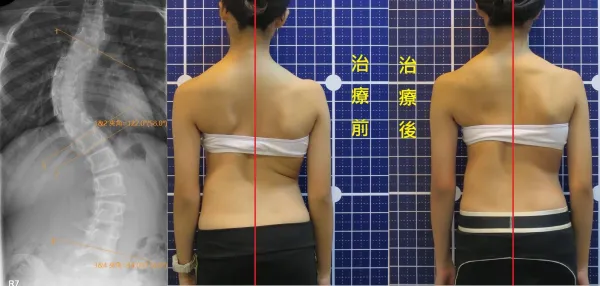 脊聲動 | 脊椎側彎 / 脊柱側彎  矯正成功分享
