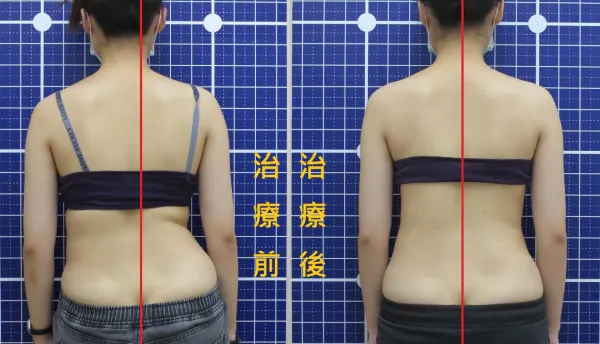 脊聲動 | 脊椎側彎 / 脊柱側彎  矯正成功分享
