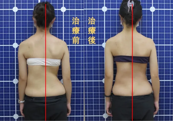 脊聲動 | 脊椎側彎 / 脊柱側彎  矯正成功分享