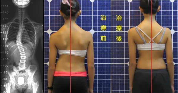 脊聲動 | 脊椎側彎 / 脊柱側彎  矯正成功分享