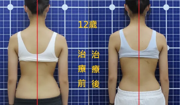 脊聲動 | 脊椎側彎 / 脊柱側彎  矯正成功分享