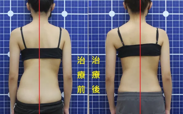 脊聲動 | 脊椎側彎 / 脊柱側彎  矯正成功分享