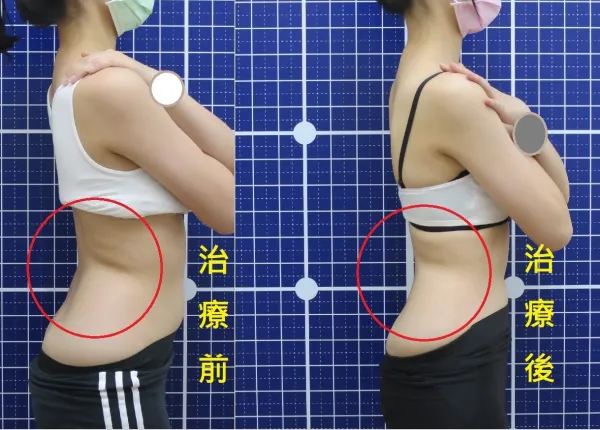 脊聲動 | 脊椎側彎 / 脊柱側彎  矯正成功分享