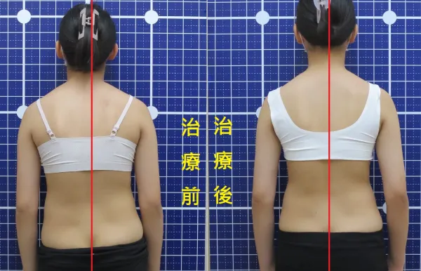 脊聲動 | 脊椎側彎 / 脊柱側彎  矯正成功分享