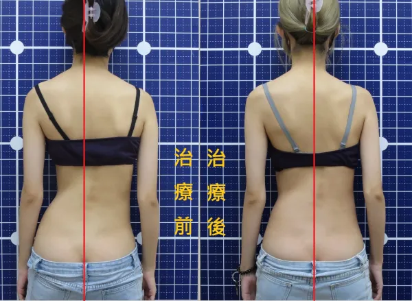 脊聲動 | 脊椎側彎 / 脊柱側彎  矯正成功分享