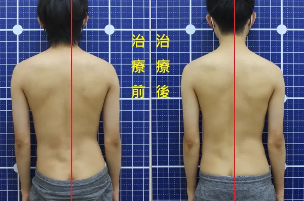 脊聲動 | 脊椎側彎 / 脊柱側彎  矯正成功分享