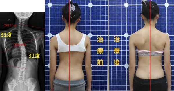 脊聲動 | 脊椎側彎 / 脊柱側彎  矯正成功分享
