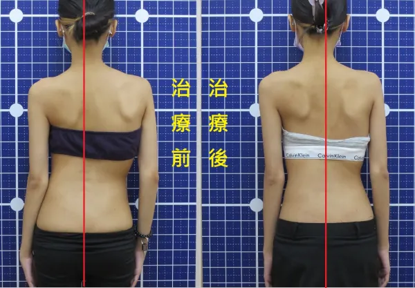 脊聲動 | 脊椎側彎 / 脊柱側彎  矯正成功分享