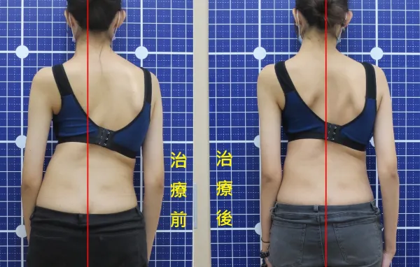 脊聲動 | 脊椎側彎 / 脊柱側彎  矯正成功分享