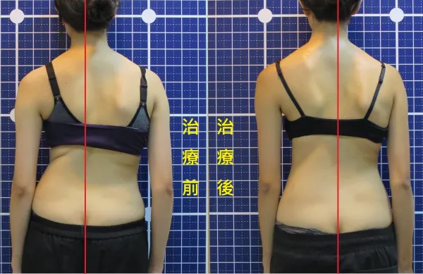 脊聲動 | 脊椎側彎 / 脊柱側彎  矯正成功分享