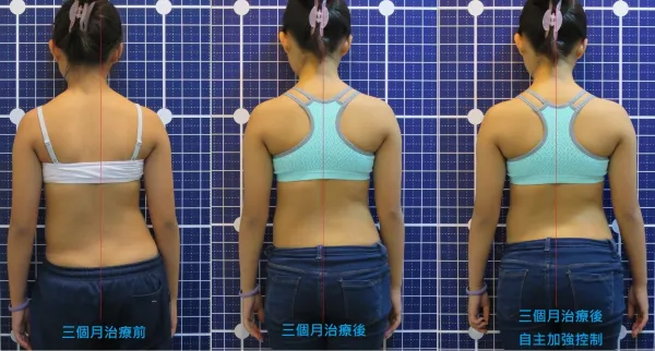 脊聲動 | 脊椎側彎 / 脊柱側彎  矯正成功分享