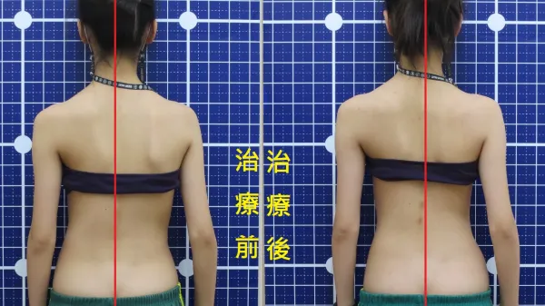 脊聲動 | 脊椎側彎 / 脊柱側彎  矯正成功分享