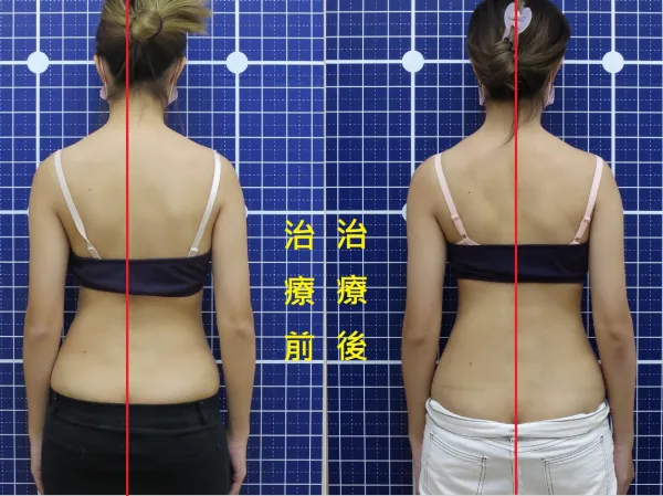 脊聲動 | 脊椎側彎 / 脊柱側彎  矯正成功分享